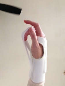 New splint after 6 weeks, thumb side of hand.