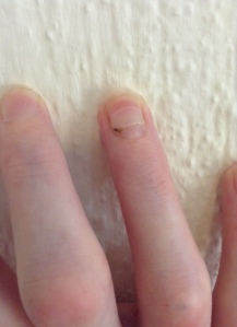 Weird ring fingernail, Pound 2 and 6.5 weeks post-op